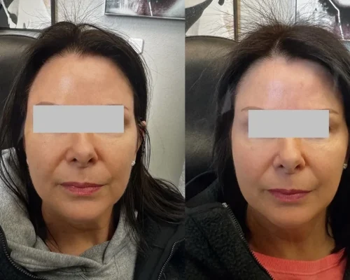 Sculptra Treatment by Pink Opal Aesthetics in San Mateo, CA